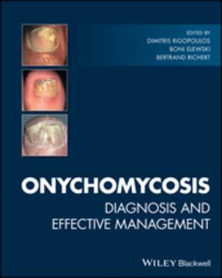 Read Online Onychomycosis: Diagnosis and Effective Management - Dimitris Rigopoulos file in PDF