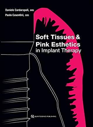 Read Soft Tissues and Pink Esthetics in Implant Therapy - Daniele Cardaropoli file in PDF